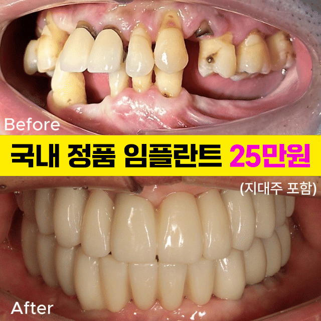 임플란트